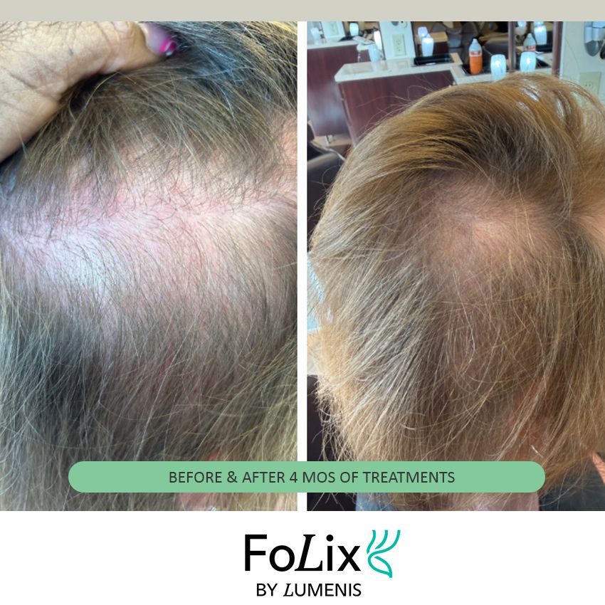 folix%20nancy-cca7abab Folix Hair Restoration - J.Bentley Hair Studio Day Spa | Powell, OH