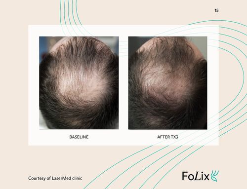 67e5a413b1d96dfc61e25a1c_67da39fa29e81af13c3a3518_man%20severe%20ba-p-500-d6bbcb58 Folix Hair Restoration - J.Bentley Hair Studio Day Spa | Powell, OH