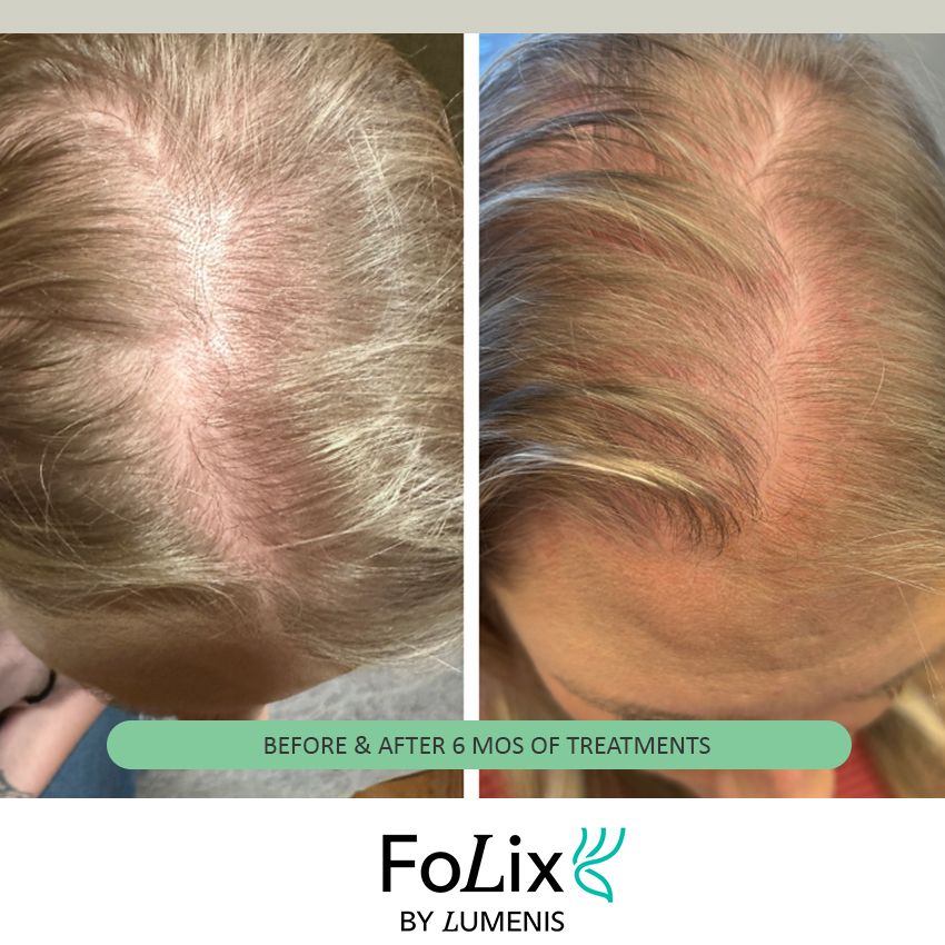 folix%20katie-dee8af48 Folix Hair Restoration - J.Bentley Hair Studio Day Spa | Powell, OH