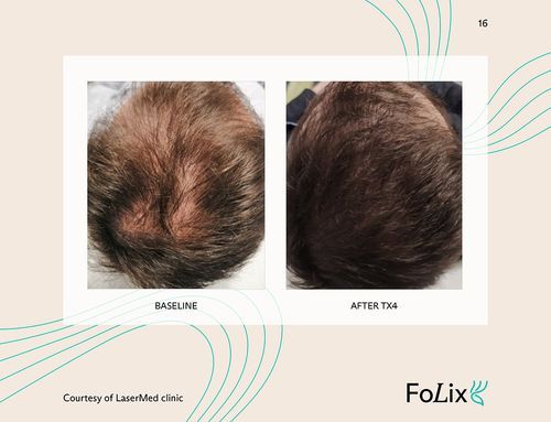 67e5a41263f8b884c089c307_67da39d699194f07c0ec9d99_male_medium%20ba-p-500-fc982e14 Folix Hair Restoration - J.Bentley Hair Studio Day Spa | Powell, OH